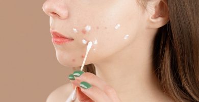 Seis tratamientos para acabar de una vez por todas con el acné adulto